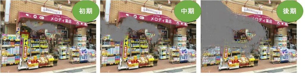 緑内障
